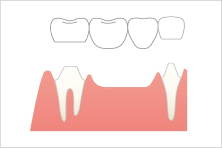 ブリッジによる補綴治療