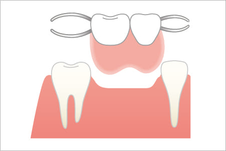 部分入れ歯による補綴治療