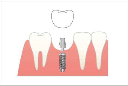 インプラント治療
