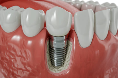 単独の歯の欠損