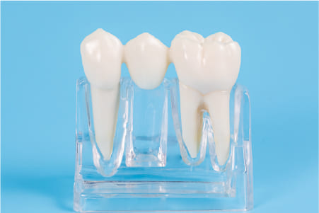 ブリッジの代替オプション